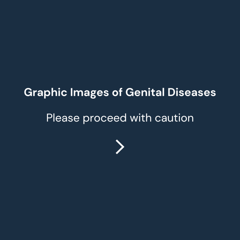 Graphic images of genital diseases
