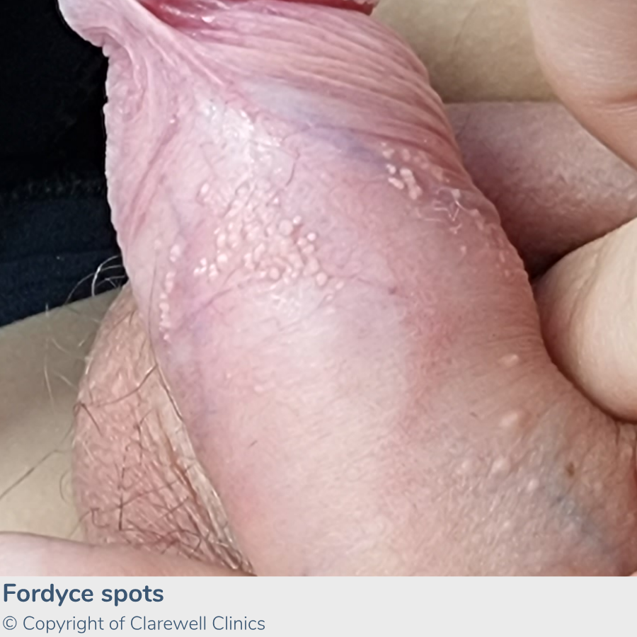 Fordyce Spots - Understanding and Managing This Common Skin Condition