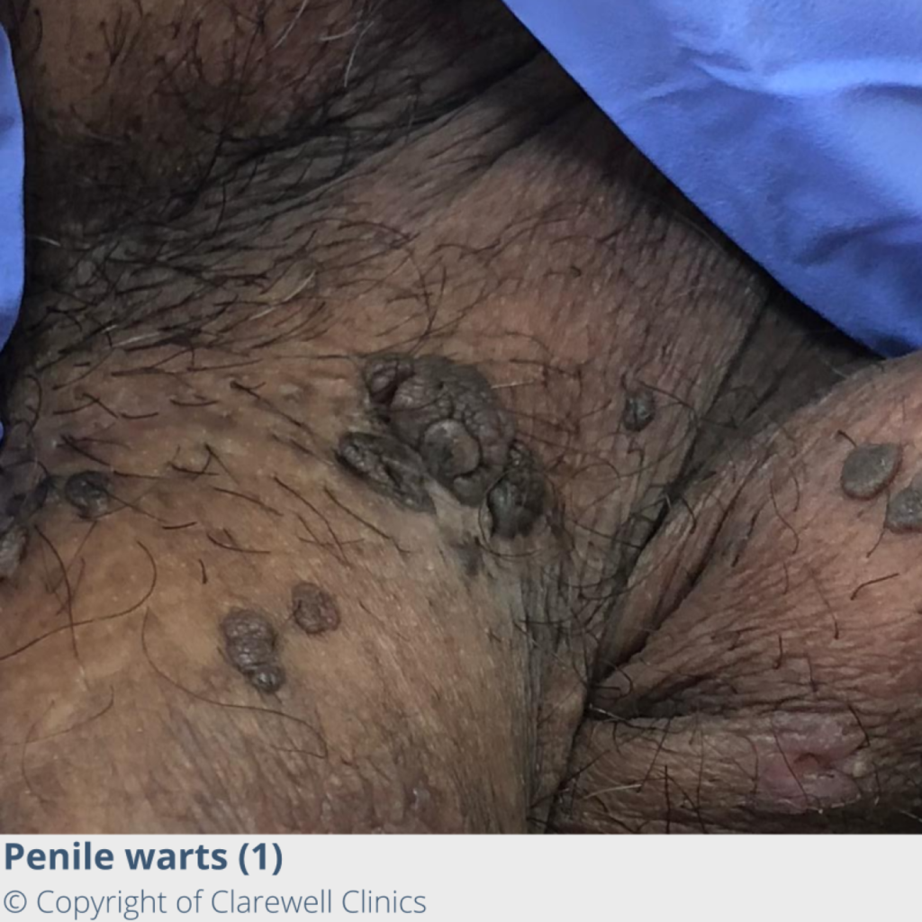 Image-of-Penile-Warts-1-Clarewell-Clinics