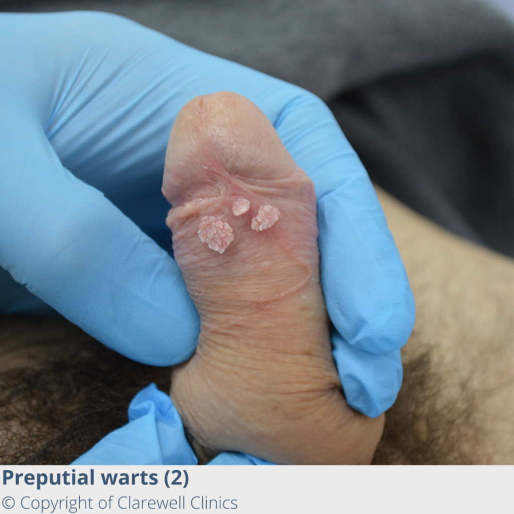 Close-up image showing the texture of Genital Warts.