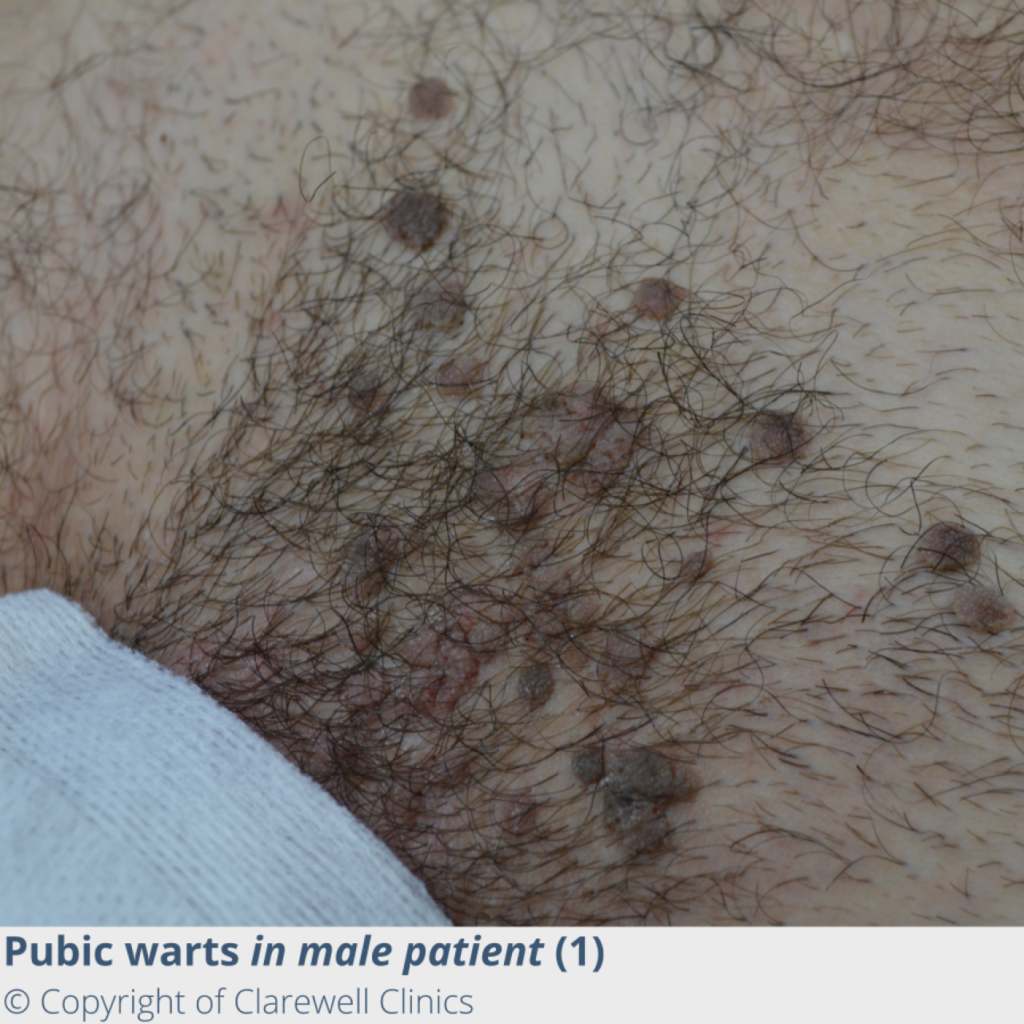 Genital Warts - Comprehensive Guide and Treatment Options