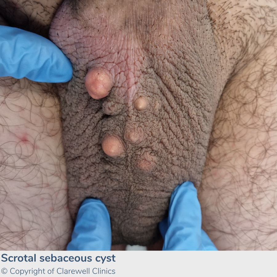 Image-of-Scrotal-sebaceous-cyst Clarewell-Clinics